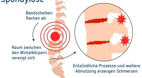 Spondylose LWS: Bandscheiben flachen ab, Raum zwischen Wirbelkörpern verengt sich. Entzündliche Prozesse und Abnutzung erzeugen Schmerzen.