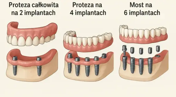 Ilustracja pokazuje trzy rodzaje protez dentystycznych: całkowitą na 2 implantach, na 4 implantach oraz most na 6 implantach.