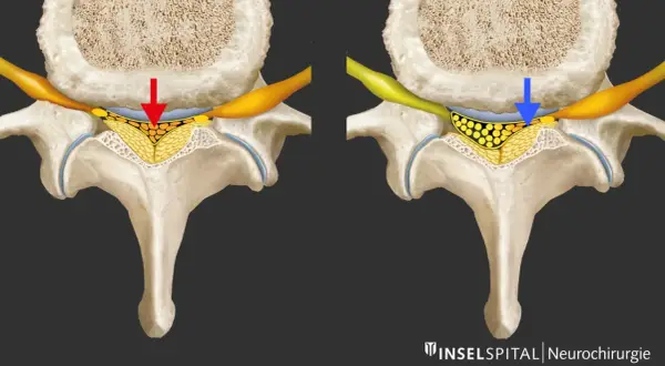 Vergleich: Spinalkanalstenose LWS mit Druck (rot) vs. Entlastung (blau). Die Darstellung zeigt, wie sich die Nervenwurzeln bei einer Spinalkanalstenose LWS verhalten.