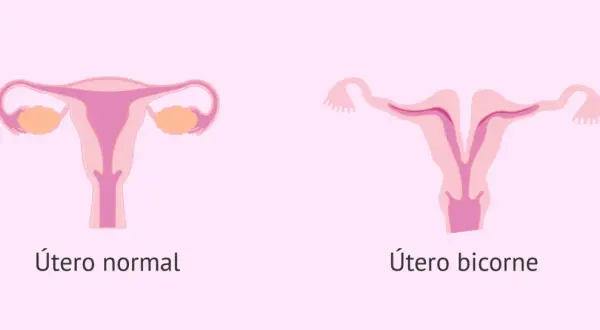 Comparación visual de un útero normal y un útero bicorne, mostrando la forma dividida de este último.