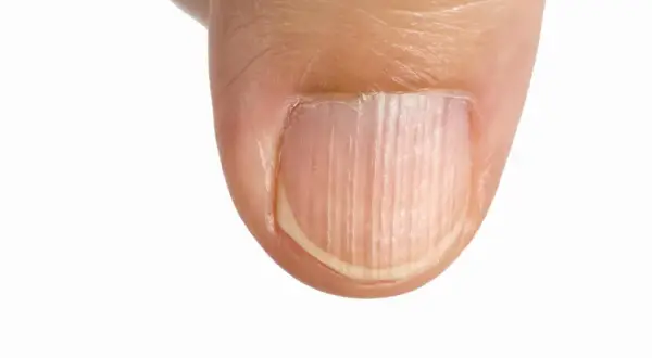 Dettaglio di un pollice con unghie rigate verticalmente, che mostrano una texture naturale e delicata.