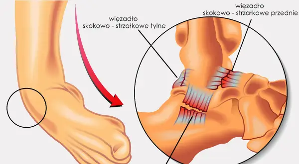 Ilustracja pokazuje skręcenie stawu skokowego, uwypuklając więzadła i mięśnie. Czerwona strzałka wskazuje kierunek urazu.