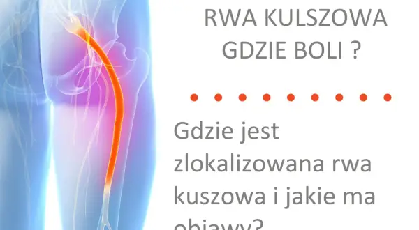 Anatomia bólu: rwa kulszowa. Ilustracja pokazuje nerw kulszowy, który może powodować ból.