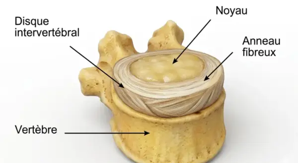 Disque intervertébral, noyau et anneau fibreux, montrant la structure d'une vertèbre, essentielle pour comprendre une hernie discale.