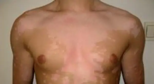 Skóra klatki piersiowej z widocznymi jasnymi plamami, które mogą być objawem vitiligo. Co to jest vitiligo? To choroba autoimmunologiczna.