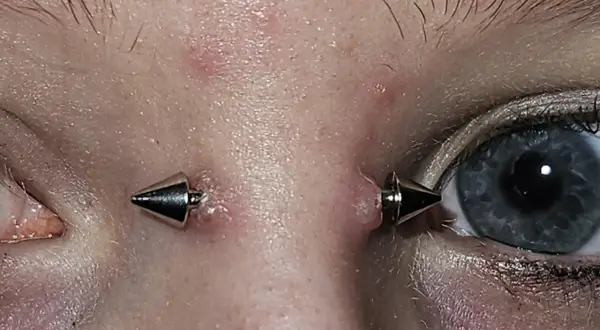 Oko z piercingiem bridge, ozdobionym dwoma metalowymi stożkami. Skóra wokół jest lekko zaczerwieniona.