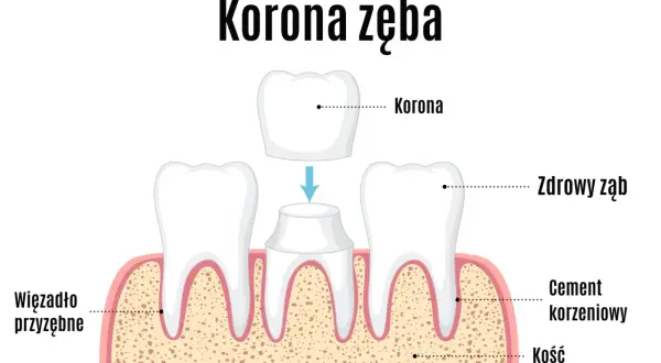 Ilustracja pokazuje proces zakładania korony na ząb. Dwa zdrowe zęby po bokach, a w środku ząb przygotowany do założenia korony, która jest umieszczona nad nim.