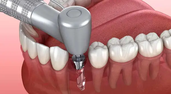 Procedimiento dental para colocar un implante. Conocer el coste de un implante dental es clave para tu salud bucal.