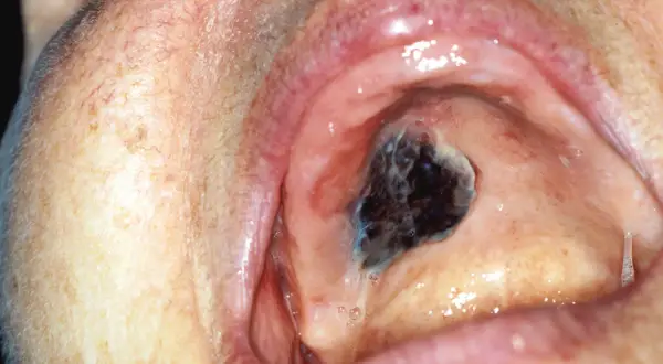 Lesione scura e irregolare sul palato, sospetto melanoma orale.