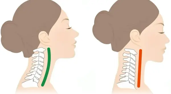 Illustration visar en halsryggrad med en grön markering som indikerar en normal kurva, och en röd markering som visar en rakare nacke, potentiellt relaterat till cervikal spondylos.