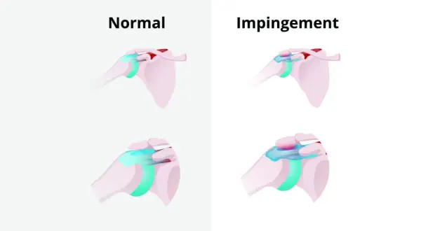 Schultergelenk: Normal vs. Impingement. Die obere Reihe zeigt eine gesunde Schulter, die untere zeigt das Impingement-Syndrom, das Schmerzen bei bestimmten Schlafpositionen verursachen kann.