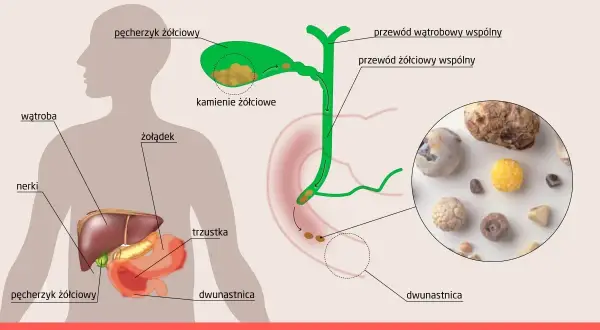 Anatomia człowieka z zaznaczonym pęcherzykiem żółciowym i kamieniami żółciowymi. Obok zdjęcie kamieni.