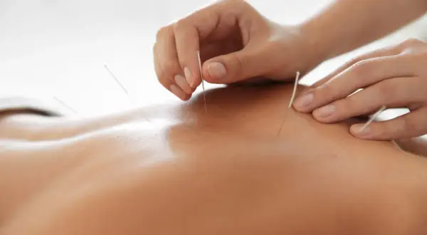 Main d'acupuncteur plaçant des aiguilles sur le dos d'une personne. L'acupuncture effet au bout de combien de temps ?