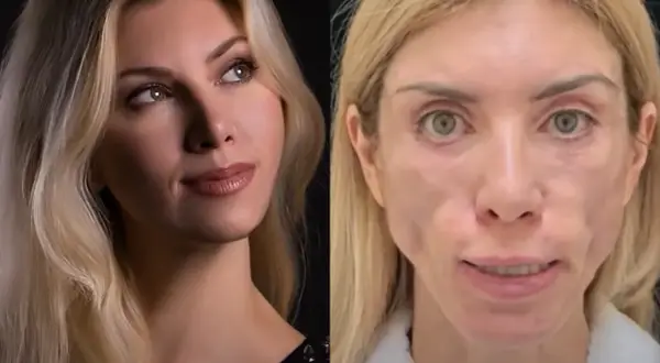 Porównanie: przed i po zabiegu liftingu twarzy nieudany. Po prawej stronie widać niepokojące zmiany.