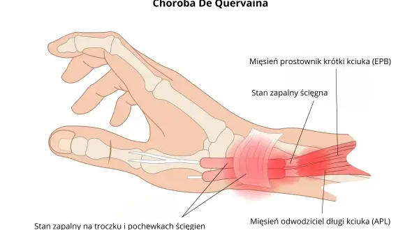 Ilustracja anatomiczna dłoni z zaznaczonym zapaleniem ścięgien kciuka (choroba De Quervaina).