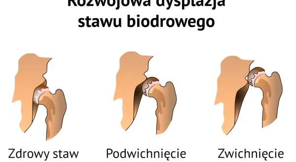 Poduszka Frejki: Jak długo? Decyzja ortopedy i Twoja rola