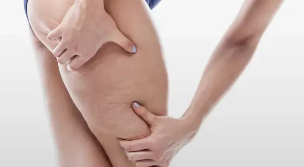 Mani che stringono la coscia, evidenziando la pelle con segni di cellulite, forse un effetto di 10 kg di ritenzione idrica.