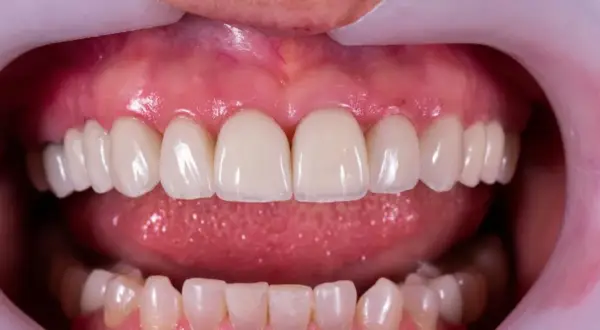 Piękne, białe zęby po zabiegu. Dowiedz się, jak wybielić zęby i osiągnąć taki efekt.