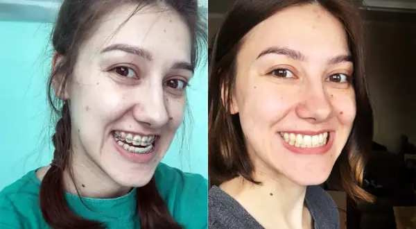 Przed i po leczeniu ortodontycznym. Czy progenia to problem? Zobacz, jak aparat zmienił uśmiech.