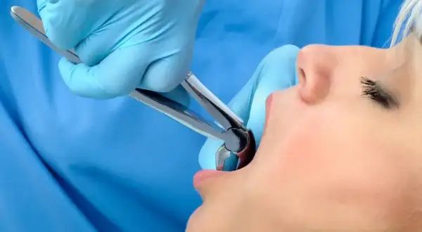 Dentysta w niebieskich rękawiczkach używa kleszczy do ekstrakcji zęba. Pacjentka z otwartymi ustami czeka na moment, kiedy kawa po wyrwaniu zęba będzie już tylko wspomnieniem.