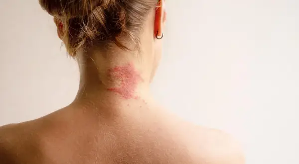 Roter, schuppiger Ausschlag am Nacken, der auf Neurodermitis hindeutet. Suche nach Neurodermitis Hausmittel zur Linderung.