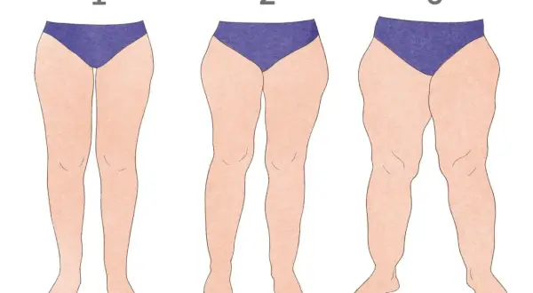 Ilustracja przedstawia trzy pary nóg o różnym stopniu lipodemi: 1 - łagodny, 2 - umiarkowany, 3 - zaawansowany.