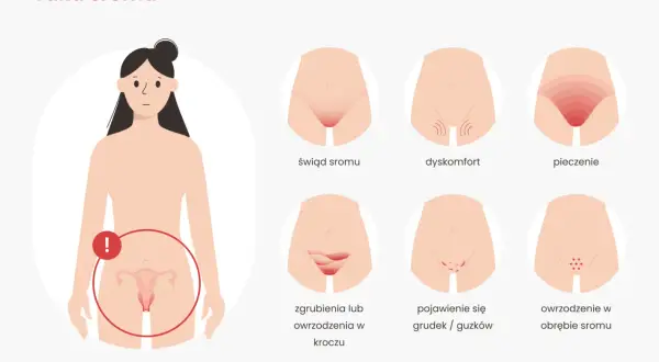 Ilustracja przedstawia wczesne objawy raka sromu: świąd, pieczenie, dyskomfort, owrzodzenia i grudki.