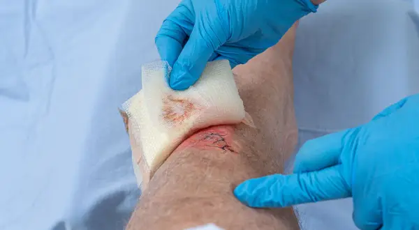 Ein Bein mit einer genähten Wunde und Anzeichen schlechter wundheilung wird mit einem Verband versorgt.