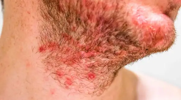 Gros plan sur la barbe d'un homme, montrant une irritation et une rougeur au cou, avec quelques boutons visibles.