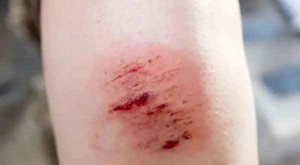 Otarte otarte kolano, zaczerwienione i lekko krwawiące. Potrzebuje **oktaseptal** do dezynfekcji.