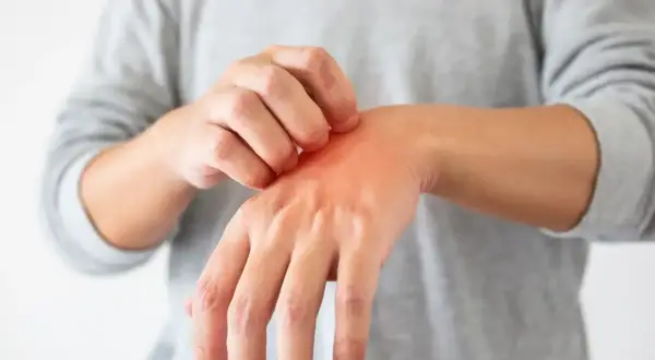 Juckende Hand, die sich kratzt. Ein roter Ausschlag deutet auf eine wunde Stelle hin, für die Hausmittel gesucht werden.