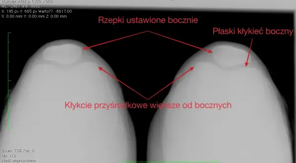 Zwichnięcie rzepki: ile trwa rehabilitacja? Od 4 tyg. do roku