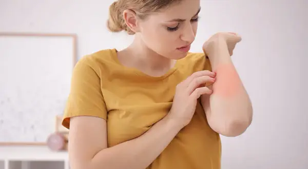 Alergia na roztocza: objawy skórne, AZS i jak sobie z nimi radzić