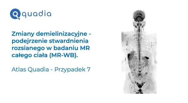 Badanie MR całego ciała wykazało zmiany demielinizacyjne, sugerujące stwardnienie rozsiane. Atlas Quadia, przypadek 7.