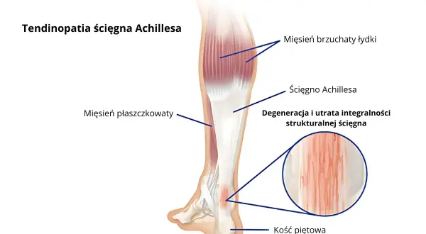 Ilustracja anatomiczna ścięgna Achillesa z zaznaczonymi mięśniami łydki, ścięgnem i kością piętową.