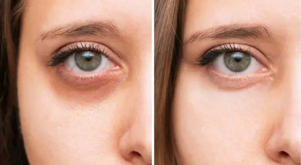 Vorher/Nachher-Vergleich: Ein blasses Gesicht mit deutlichen Augenringen wird durch eine Behandlung aufgehellt, die die Augenringe reduziert.
