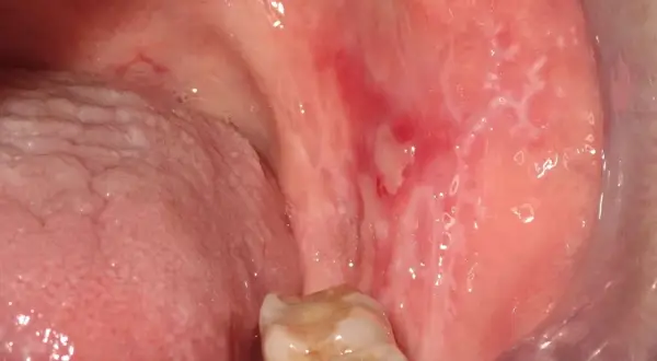 Lesioni biancastre e rosse nella bocca, indicative di lichen planus orale, in attesa di terapia.