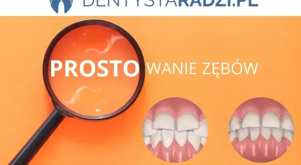 Licówki na krzywe zęby: przed i po. Proste rozwiązanie dla idealnego uśmiechu.