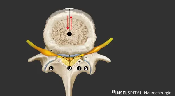 Querschnitt einer Wirbelsäule mit Darstellung der neuroforaminalen Enge. Ein Nerv (gelb) wird durch knöcherne Strukturen und Gewebe eingeengt.