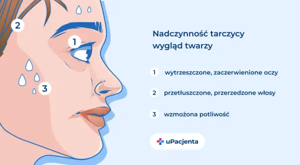 Nadczynność tarczycy: wytrzeszczone oczy (1), przetłuszczone włosy (2), wzmożona potliwość (3).