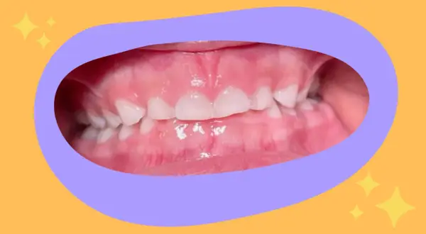 Primo piano dei denti di un bambino con un morso aperto, mostrando gli incisivi superiori e inferiori separati.