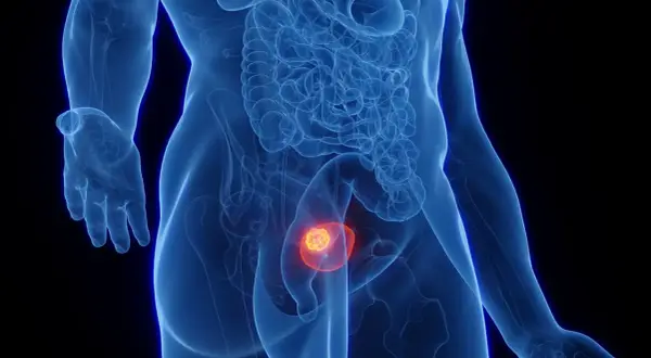Anatomical illustration showing a glowing tumor within the bladder, representing nieinwazyjny rak brodawkowaty pęcherza moczowego.