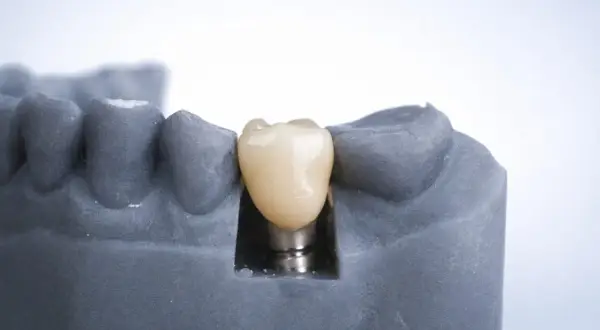 Model szczęki z implantem zębowym. Zastanawiasz się, ile kosztuje implant zęba 6? To inwestycja w Twój uśmiech.