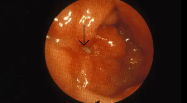Endoskopisk bild av magsäcken visar rodnad och svullnad, tecken på inflammation magsäcken. En pil pekar mot en liten vit fläck.