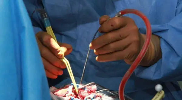 Chirurgen führen eine Hirntumor-OP durch. Hände mit Instrumenten arbeiten präzise am Gehirn.