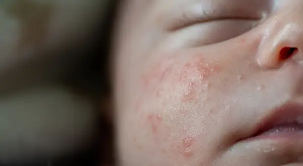 Bebé con piel atopica, mejillas enrojecidas y con pequeñas protuberancias.