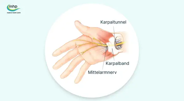 Anatomische Darstellung des Karpaltunnels, der den Mittelarmnerv und das Karpalband zeigt. Mögliche Ursachen für Karpaltunnelsyndrom Symptome.