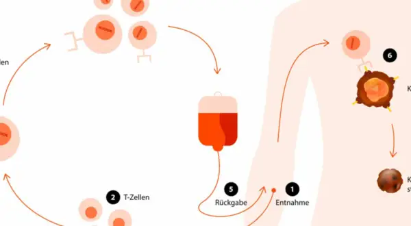 Schema zeigt, wie schnell wirkt Immuntherapie: T-Zellen werden entnommen, modifiziert (CAR-T-Zellen) und zurückgegeben, um Krebszellen zu bekämpfen.