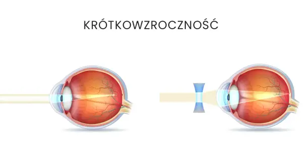 Krótkowzroczność: Jakie soczewki wybrać? Poradnik