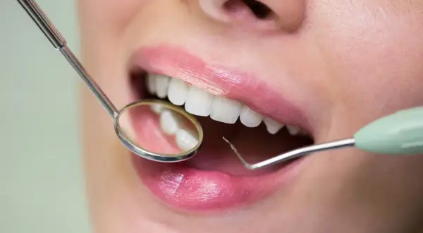 Usta kobiety z białymi zębami, badane lusterkiem dentystycznym. Na dziąśle widoczna jest mała, biała kulka.